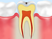 初期状態の虫歯